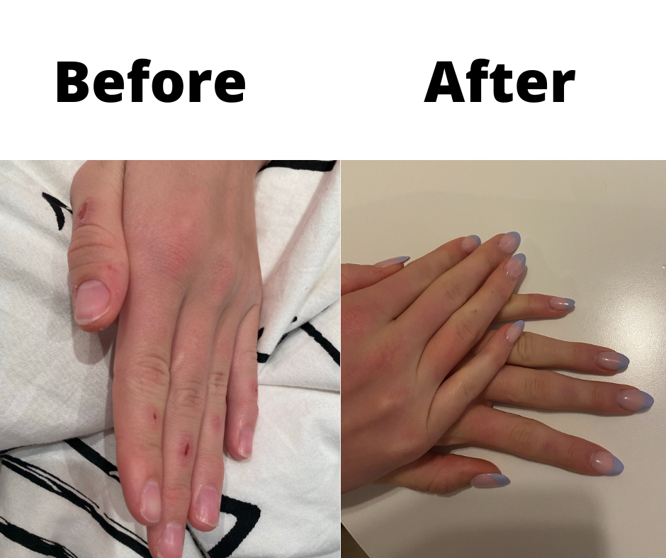 Hands showing before and after treatment